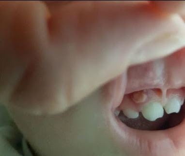 Fistola gengiva dente