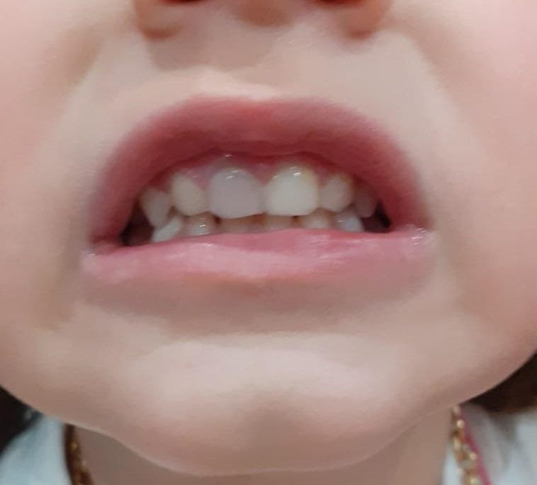 Traumatologia dentale pediatrica