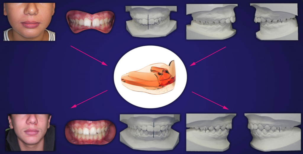 morso profondo anteriore