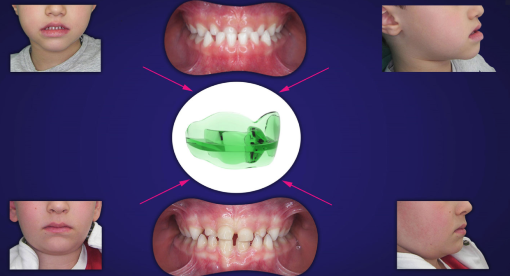 morso inverso anteriore