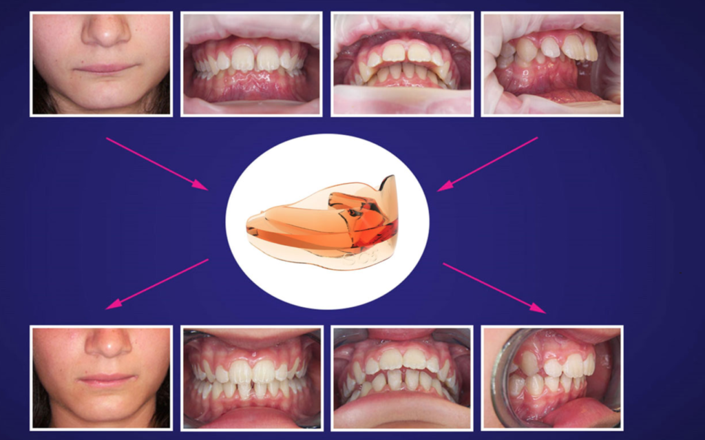 II classe scheletrica