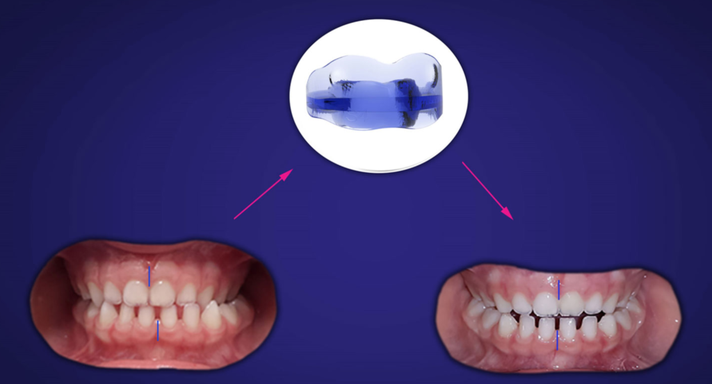 morso crociato monolaterale