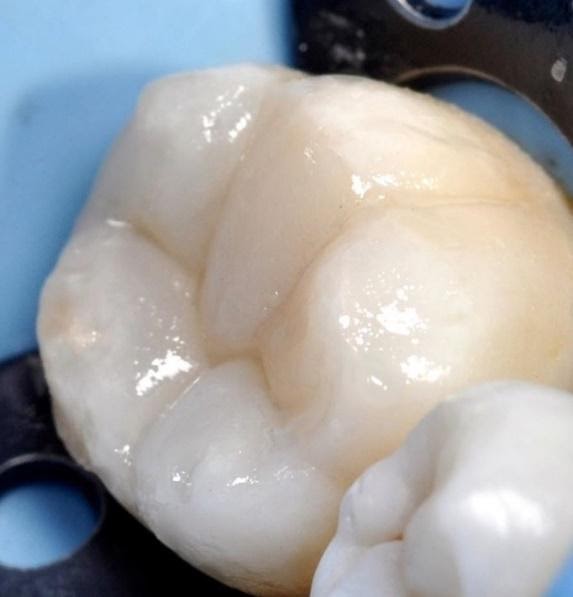 Denti con sistemi ingrandenti